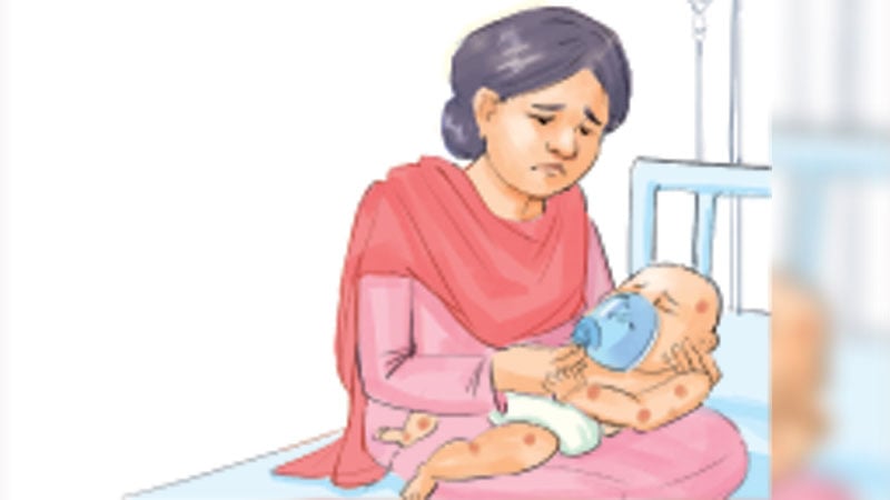 হামের উপসর্গে মৃত্যু ৮০০ ছুঁইছুঁই